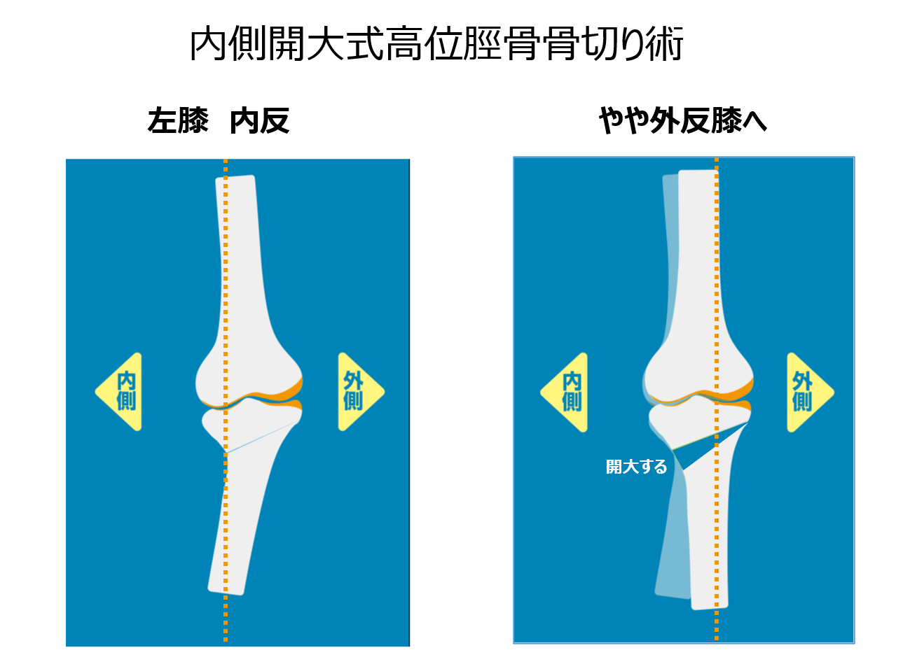 膝・足関節および足趾の骨切り術 ベストな手技のコツ＆トラブルシュ-ティング/メジカルビュ-社/安田和則（単行本） 膝・足関節および足趾の骨切り術−ベストな手技のコツ&トラブル